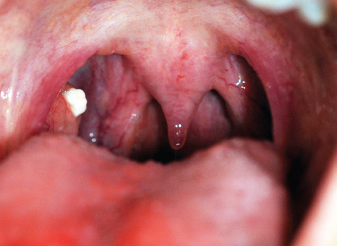 What Is That White Stuff In The Back Of Your Throat