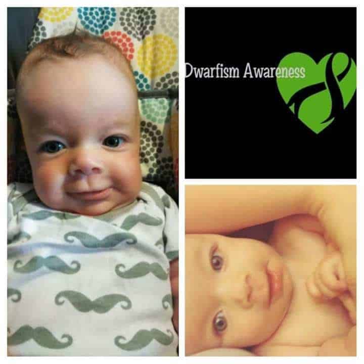 Buy BBQ Dinners To Help Cover Medical Expenses Of 9-Month Old With Dwarfism